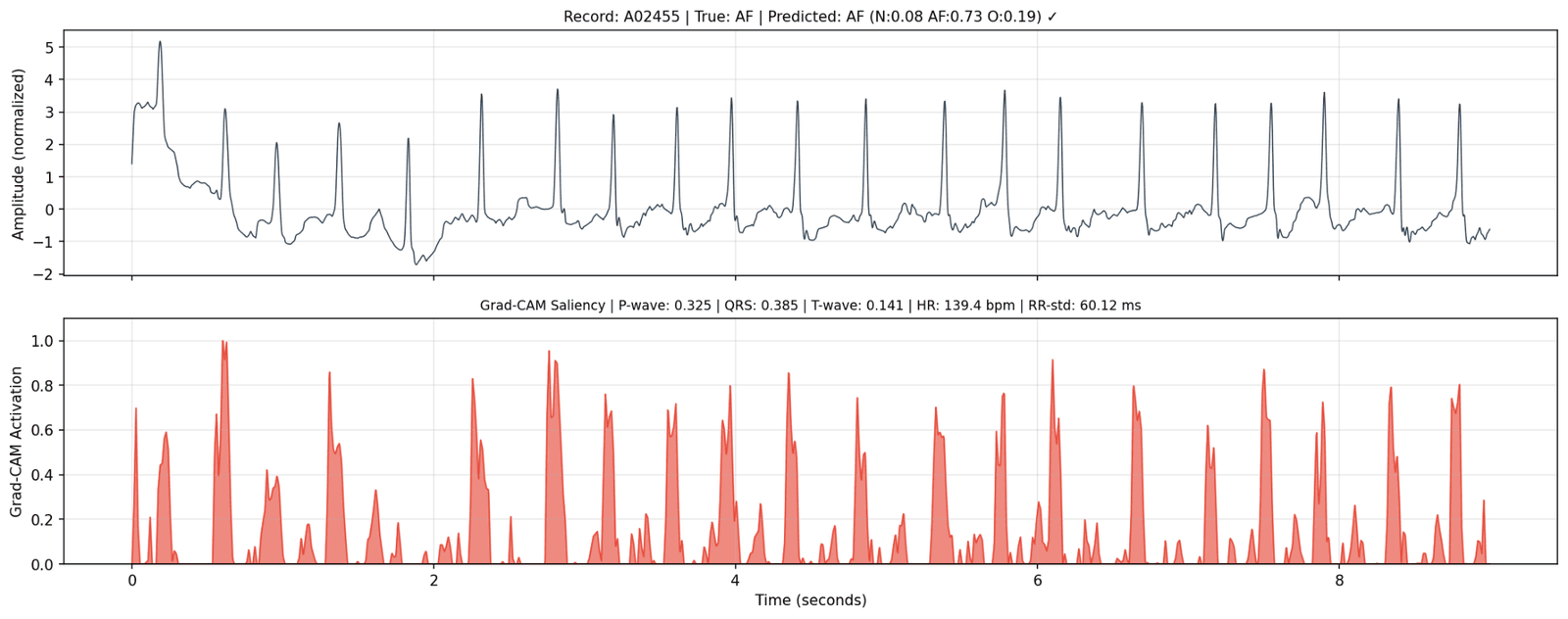 An ECG waveform above a Grad-CAM activation trace on the same time axis, with peaks marking the regions the model attended to